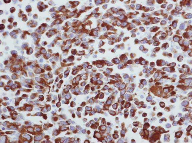 60-0026 61-0026 Ms x Desmin Rbahdomyosarcoma