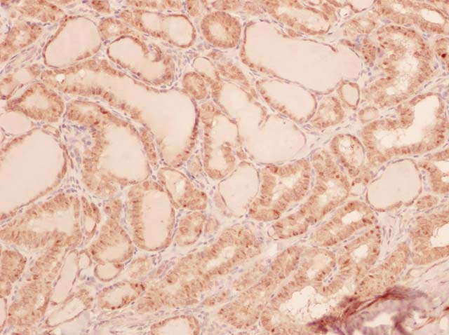 60-0133 61-0133 Galectin-3 Thyroid ca 