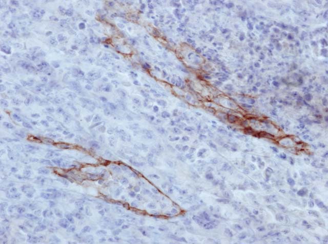 60-0100 61-0100 Ms x D2-40 Stained ALCL 