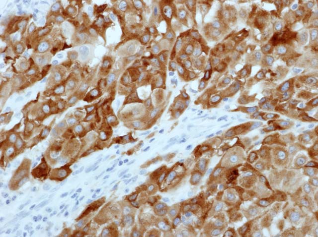 60-0092 61-0092 Ms x Melan-A stainined Melanoma 
