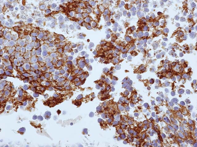 60-0139 61-0139 Ms x PLAP stained testis seminoma 