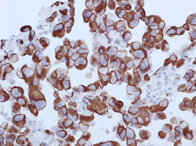 60-0077 61-0077 Ms anti-Desmin clone GM006 stained Rbahdomyosarcoma 