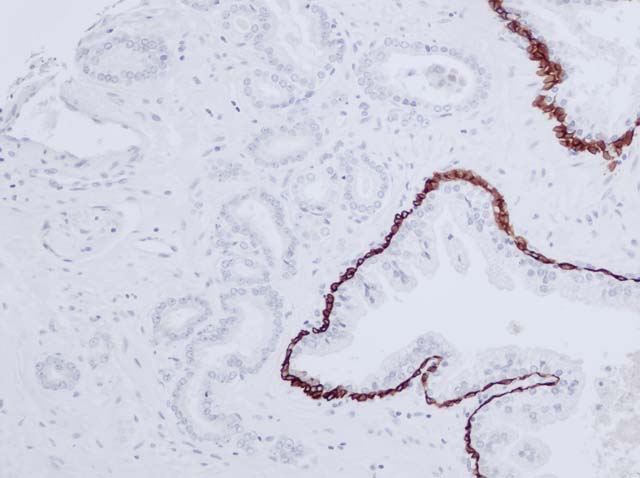 60-0025 61-0025 Ms x CK HMW Prostate cancer