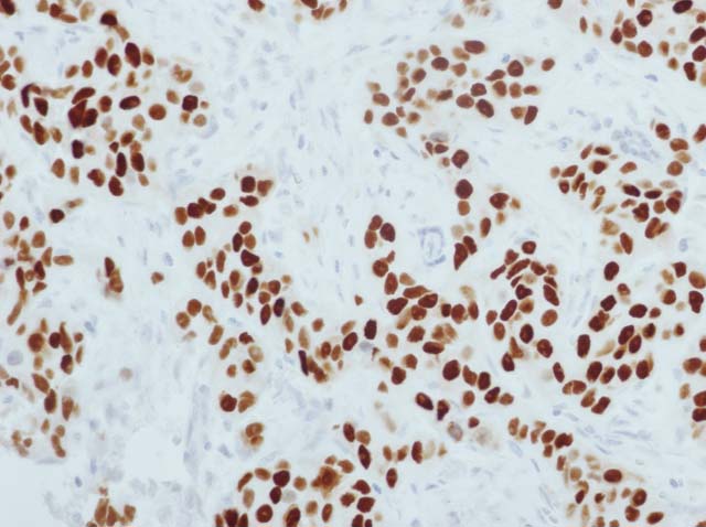 60-0056 61-0056 RbMab x PR breast cancer