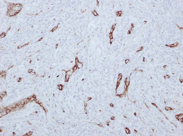 60-0109 61-0109 Rb x vWF Follicular Dentritic Cell Tumor 