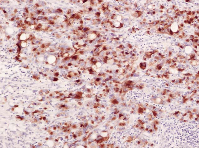 60-0042 61-0042 Ms x Melanosome Melanoma