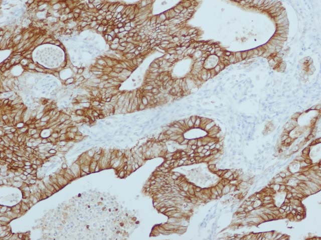 60-0053 61-0053 Ms x pan CK AE1_AE3 endometrial ca 