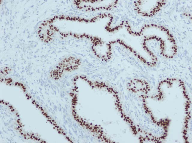 60-0056 61-0056 RbMab x PR breast
