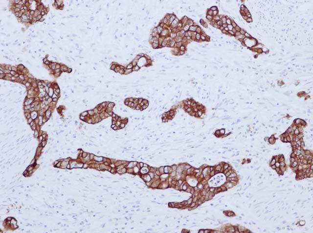 60-0112 61-0112 Cytokeratin 19 Gastric Cancer 