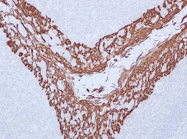 60-0016 61-0016 Ms x CK5_6 tonsil 