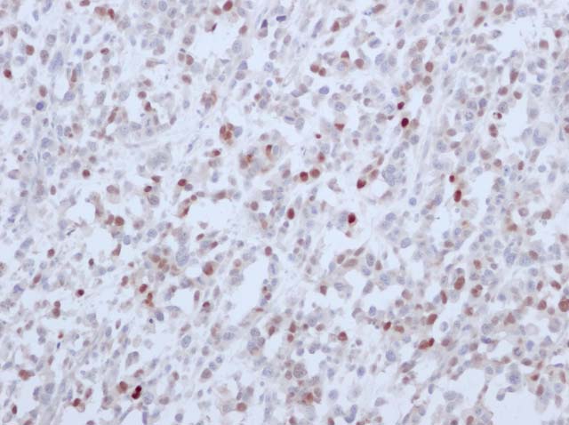 60-0149 61-0149 Ms x Myogenin stained Rhabdomyosarcoma 