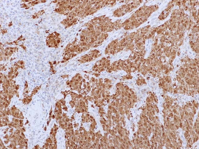60-0006 61-0006 Rb x Calretinin Epithelial Mesothelioma 