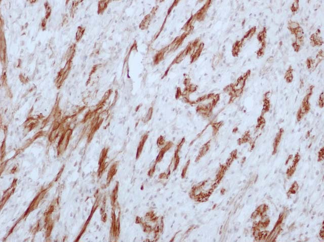 60-0107 61-0107 Rb x PTEN stained schwannoma 