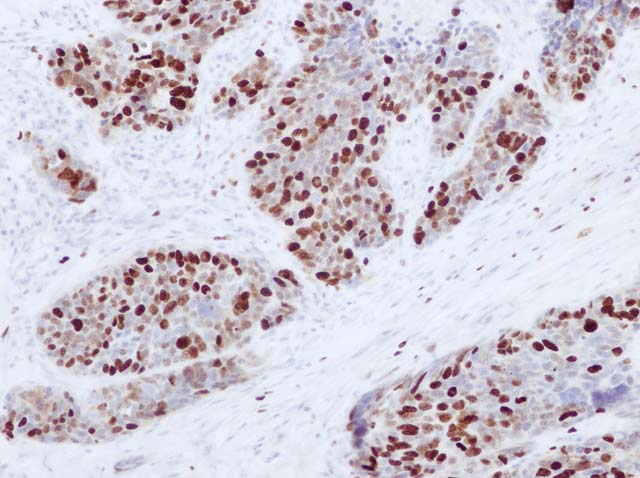 60-0078 61-0078 Ms x Ki67 clone GM010 Gastric neuroendocrine tumor x 20