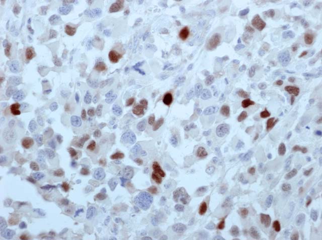 60-0149 61-0149 Ms x Myogenin stained Rhabdomyosarcoma 