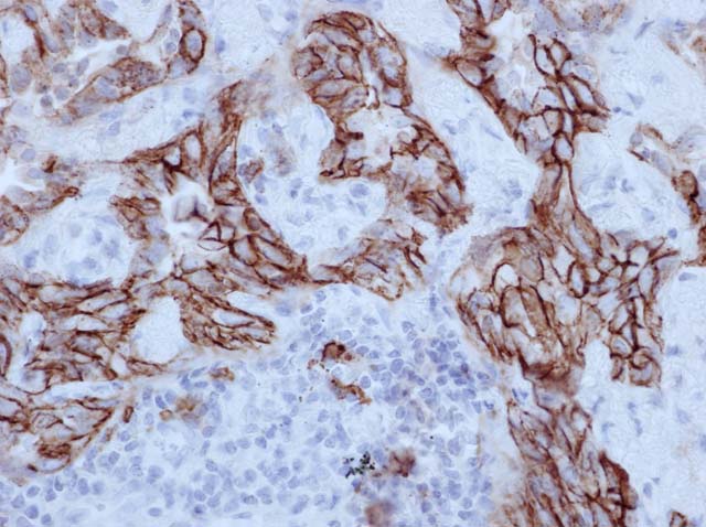 60-0108 61-0108 Ms x CD138 stained lung adenoca 