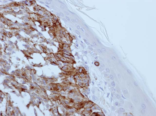 60-0042 61-0042 Ms x Melanosome stained Melanoma 