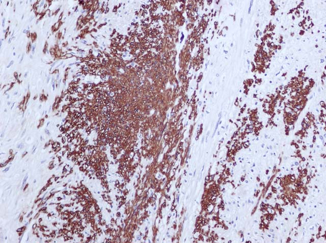 60-0001 61-0001 Ms x Actin 1A4 dil 600 Leiomyosarcoma 