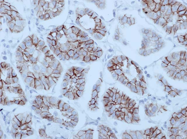 60-0028 61-0028 Ms x E-cadherin GM016 Breast Cancer 