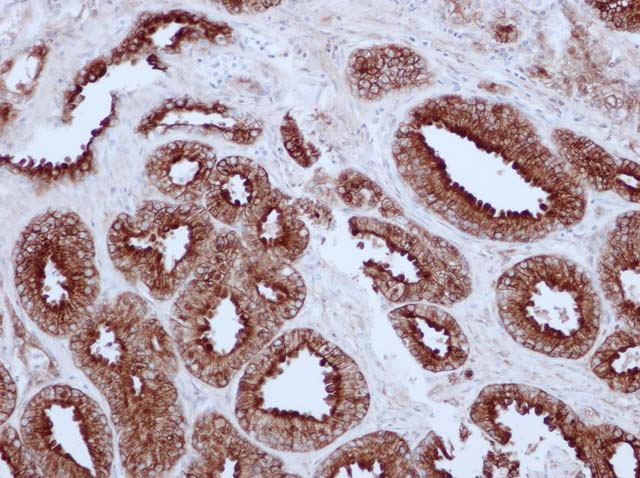 60-0104 61-0104 Ms x PsAP stained prostate cancer 
