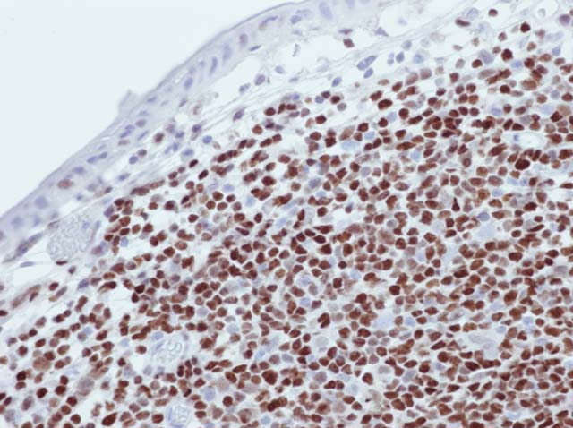 60-0090 61-0090 Rb x Cyclin D1 Mantle Cell Lymphoma 