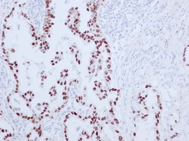 60-0065 61-0065 Ms x TTF1 Lung Cancer