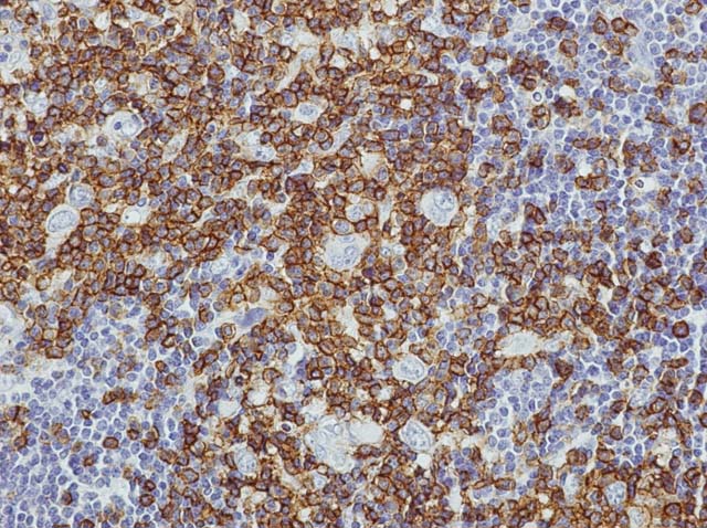 60-0013 61-0013 Ms x CD45RO Hodgkin's Lymphoma 