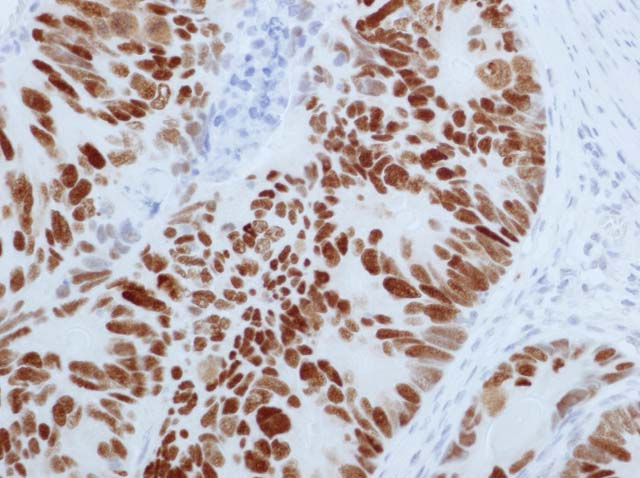 60-0050 61-0050 Ms x p53 colon ca 