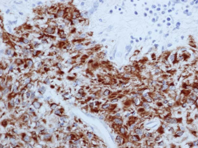 60-0032 61-0032 Rb x GFAP glioma