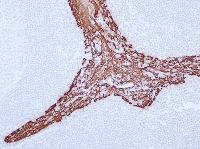 60-0016 61-0016 Ms x CK5_6 tonsil 