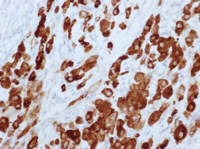 60-0111 61-0111 Ms x Inhibin alpha stained granulosa theca cell tumor of ovary 