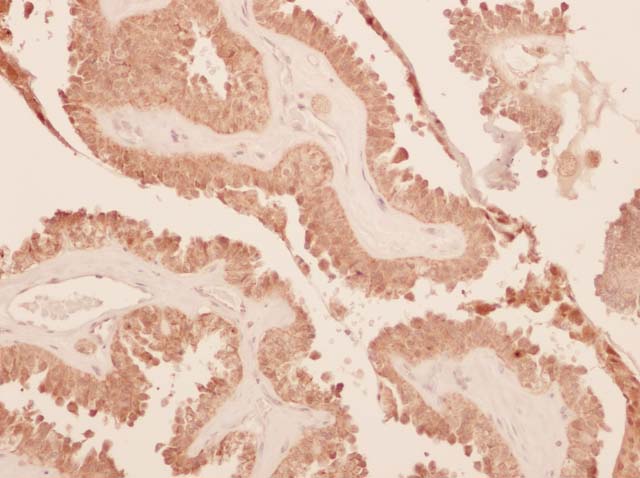 60-0133 61-0133 Galectin-3 Thyroid Cancer 