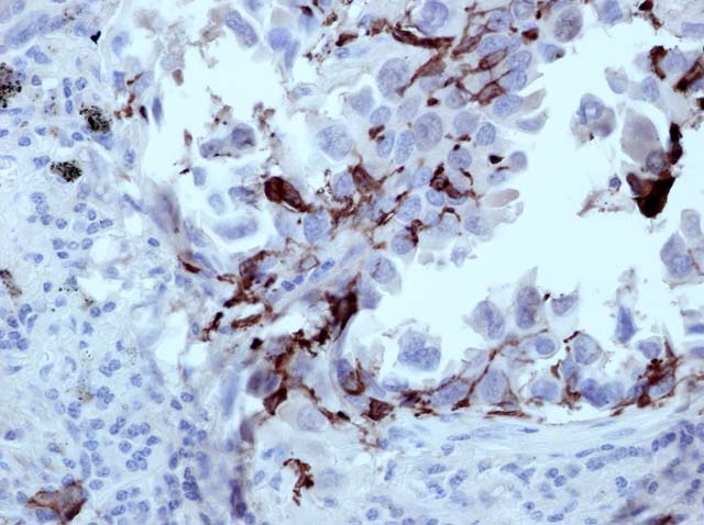 60-0143 61-0143 Ms x CD1a stained Lung Adeno Ca 