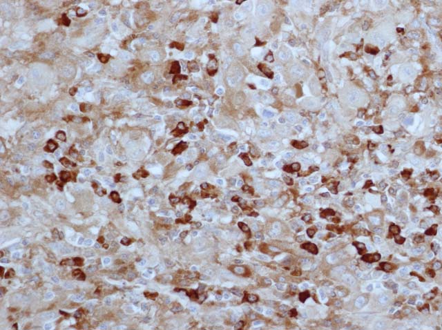 60-0038 61-0038 Ms x lambda melanoma 