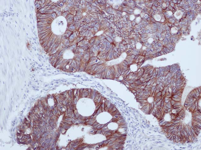 60-0132 61-0132 Ms x Epithelial Antigen Ep-Cam Stained Colon Cancer 
