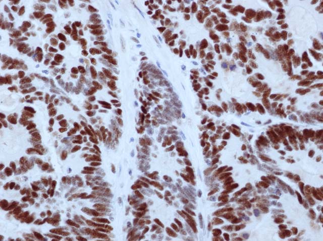 60-0158 61-0158 Ms x MSH6 stained colon ca 