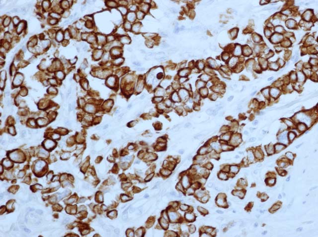 60-0022 61-0022 Ms x pan CK AE1_AE3 gastric ca 