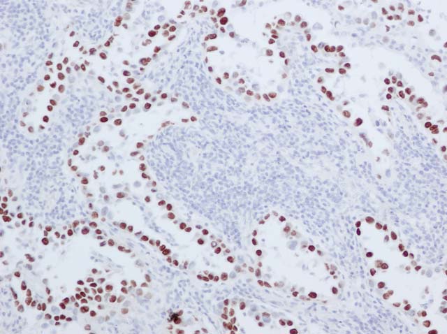 60-0065 61-0065 Ms x TTF1 Lung Ca ade 