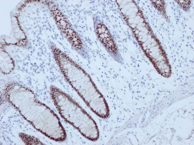 60-0161 61-0161 Rb x CDX2 stained Colon 