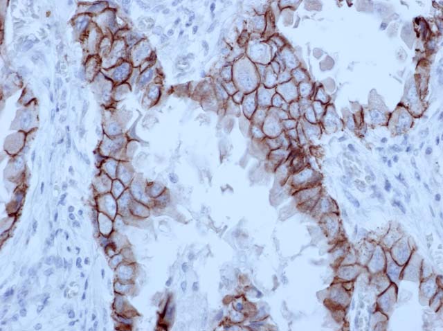 60-0028 61-0028 Ms x E-cadherin clone 4A2C7 072610 #22 Lung Adenocarcinoma 