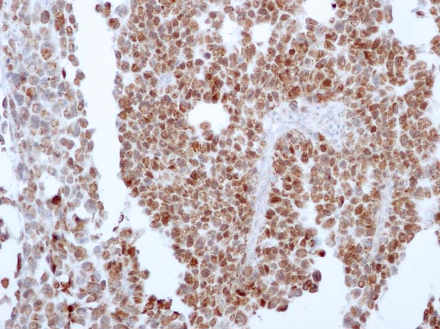 60-0101 61-0101 Ms x MyoD1 stained Rhabdomyosarcoma 