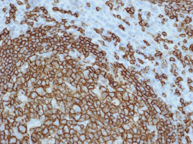 60-0010 61-0010 Ms x CD20 tonsil