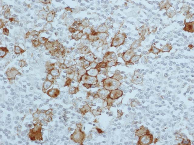 60-0007 61-0007 Ms x CD30 Hodgkin Disease 