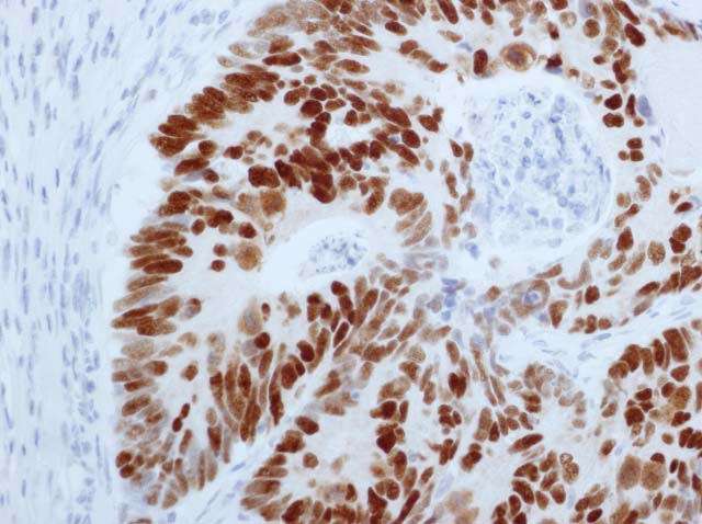 60-0050 61-0050 Ms x p53 colon cancer