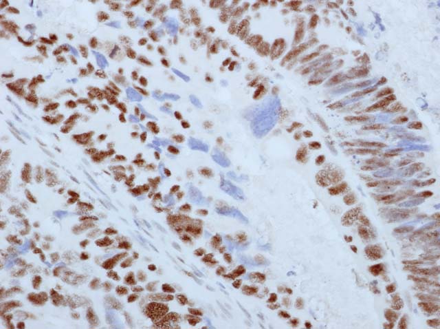 60-0079 61-0079 Ms x MLH1 GM011 stained colon cancer 