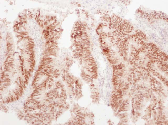60-0097 61-0097 CDX2 Colon Cancer 