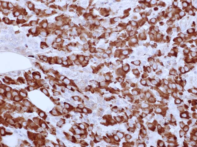60-0085 61-0085 Rb x hu Kappa stained plasmacytoma of bone 