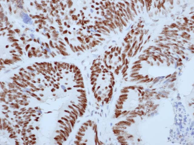 60-0079 61-0079 Ms x MLH1 GM011 stained colon cancer 