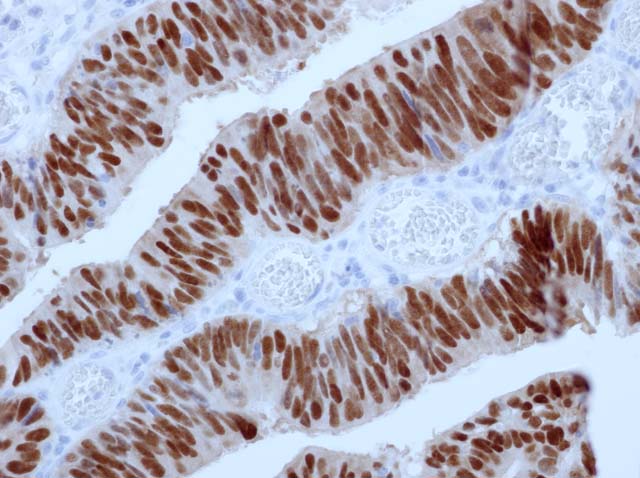 60-0161 61-0161 Rb x CDX2 stained colon ca 