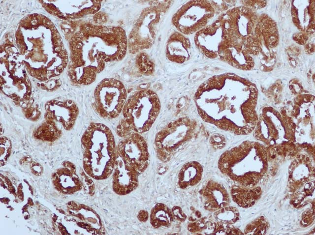 60-0058 61-0058 Rb x PSA stained prostate cancer 